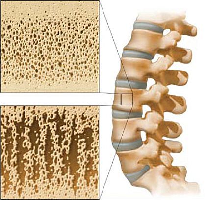 Остеопорозата: за здрави кости е нужен не само калций